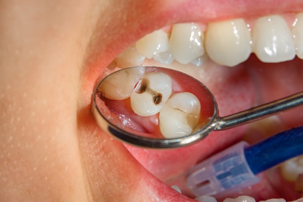 Dental Fillings Copperhill, TN